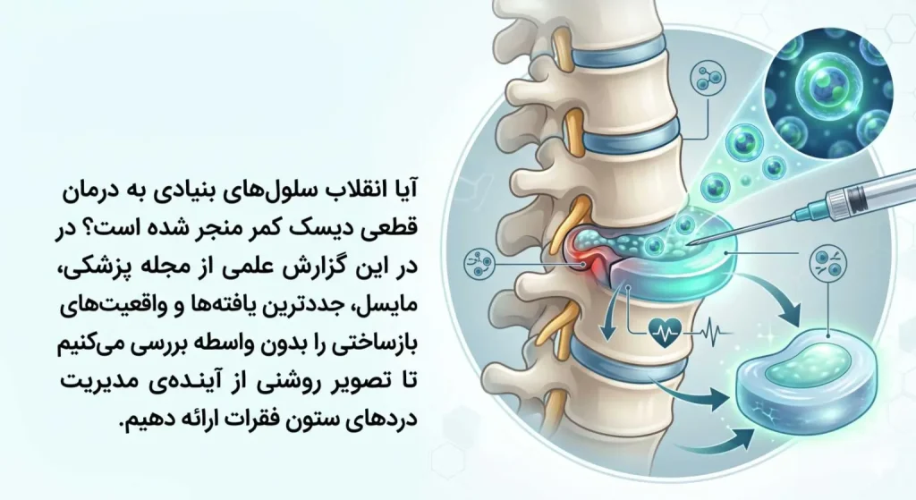 درمان دیسک کمر با سلول بنیادی