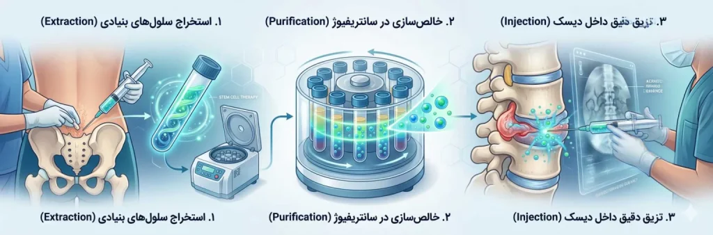 درمان دیسک کمر با سلول بنیادی