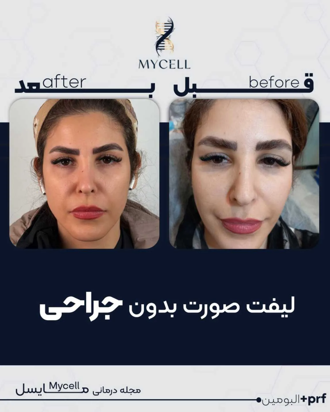 لیفت صورت بدون جراحی در مشهد