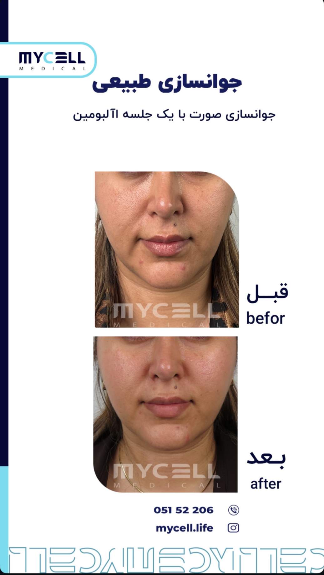 جوانسازی طبیعی با آلبومین — مایسل مدیکال