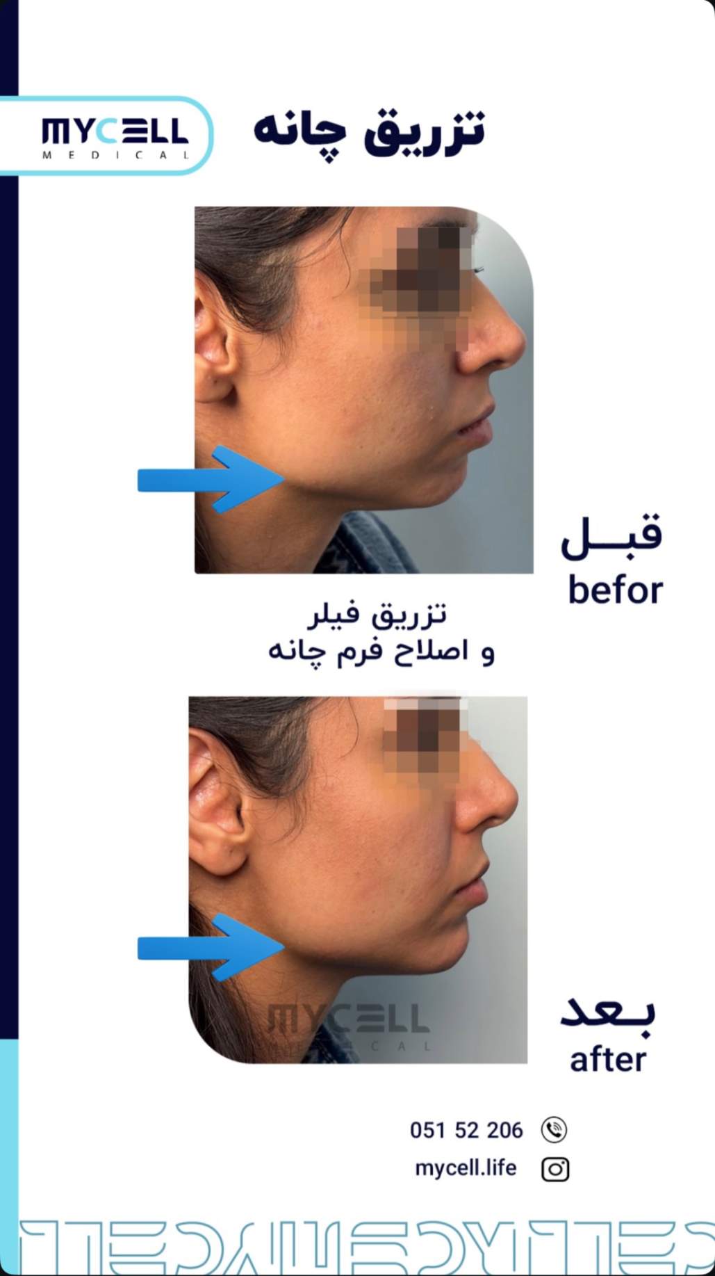تزریق فیلر و اصلاح فرم چانه — مایسل مدیکال