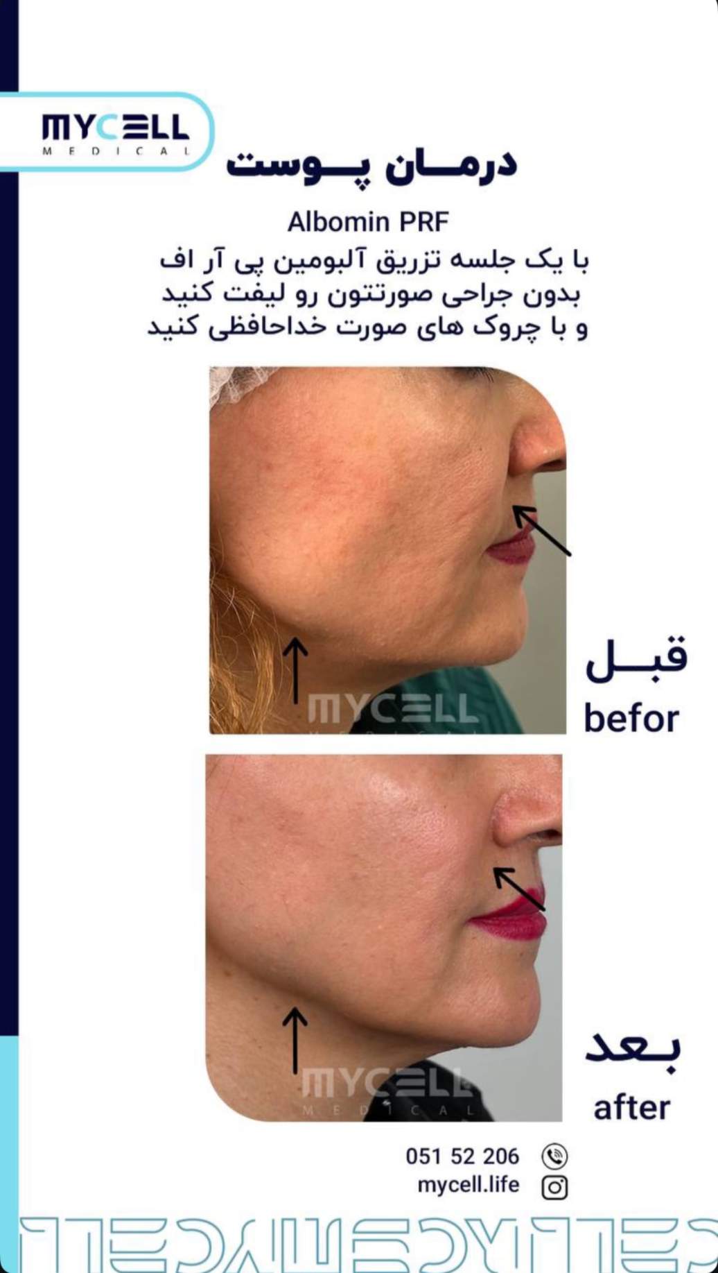 لیفت صورت بدون جراحی — آلبومین PRF — مایسل مدیکال