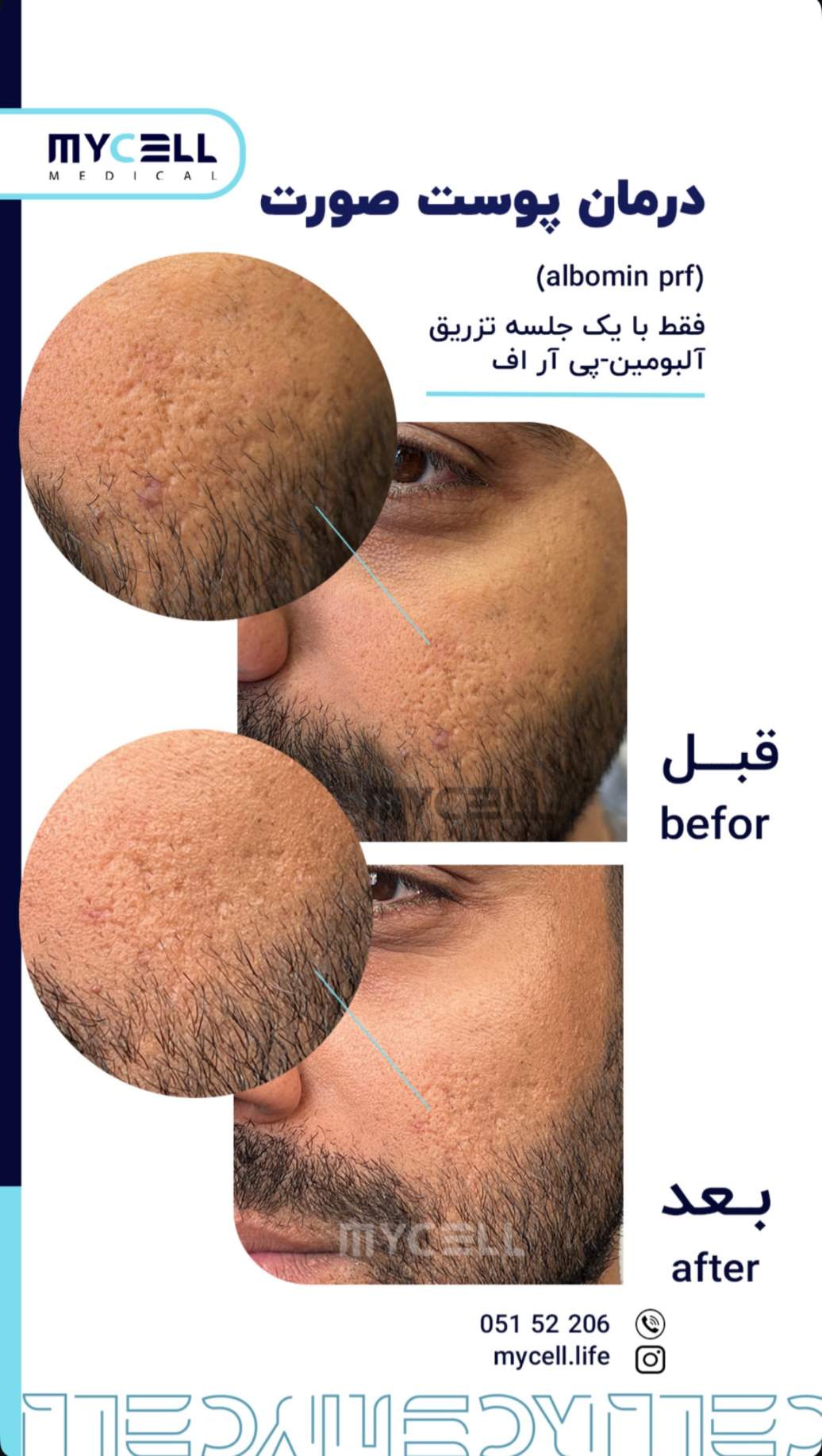 درمان پوست صورت — آلبومین PRF — مایسل مدیکال