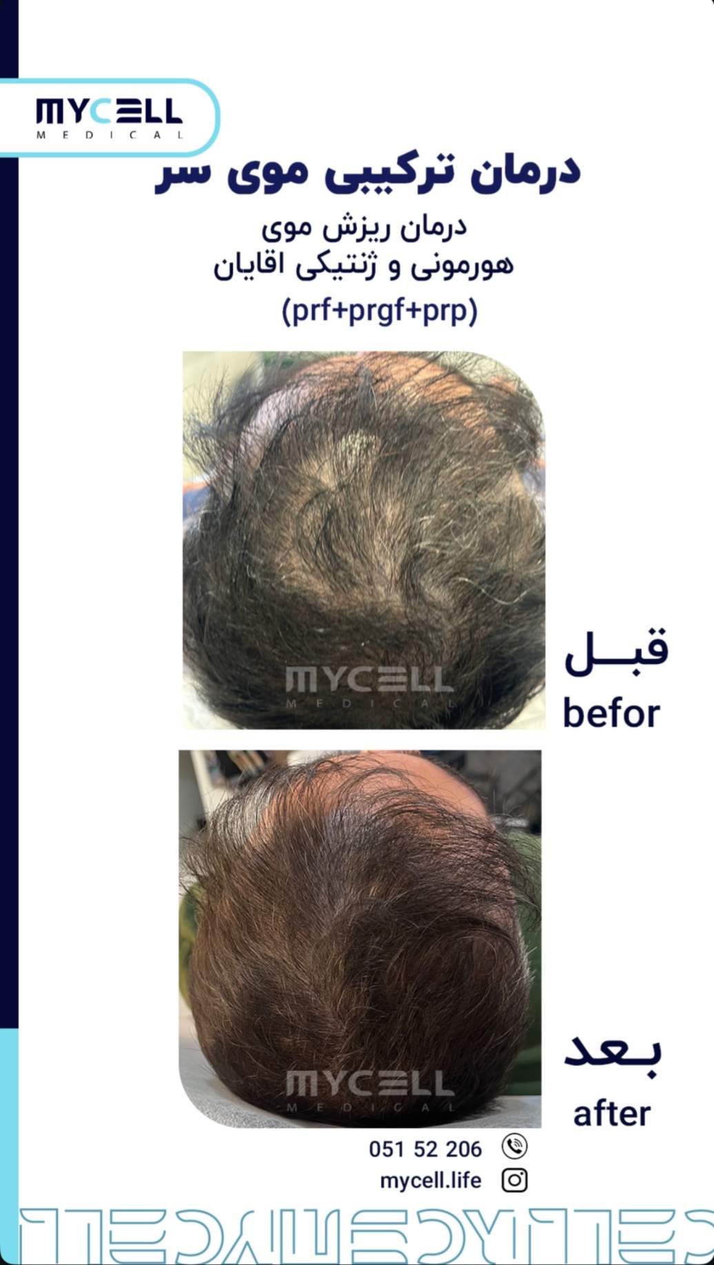درمان ترکیبی ریزش موی سر (PRF+PRGF+PRP) — مایسل مدیکال