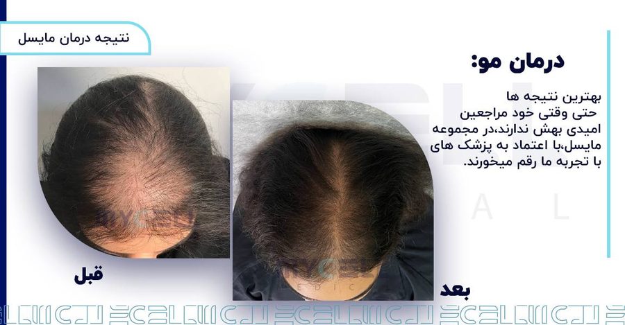 نمونه درمان ریزش مو در مایسل 1