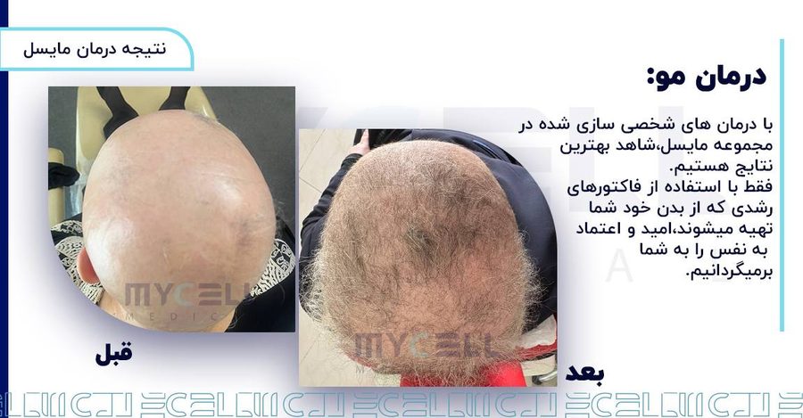 نمونه درمان ریزش مو در مایسل 2