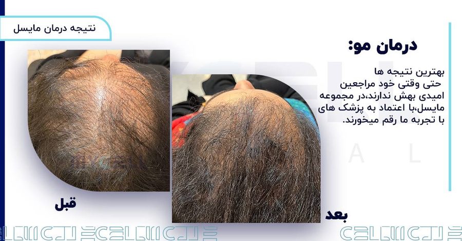 نمونه درمان ریزش مو در مایسل 3