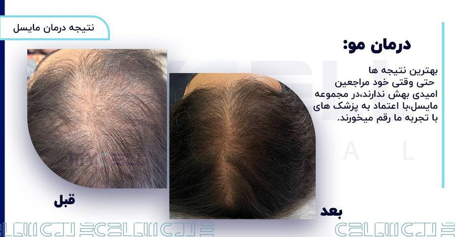 نمونه درمان ریزش مو در مایسل 4