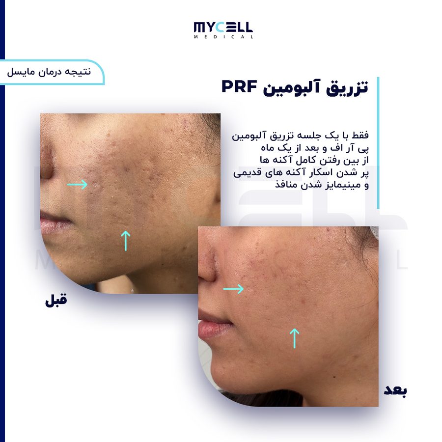 نمونه درمان ریزش مو در مایسل 5