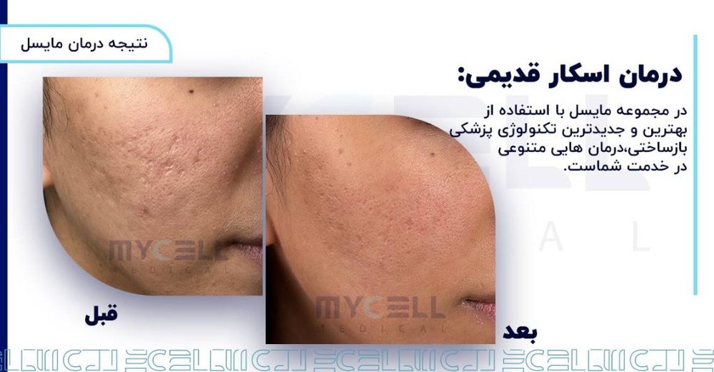 نتیجه قبل و بعد درمان اسکار پوست و جای جوش در مشهد — ساختمان پزشکی مایسل