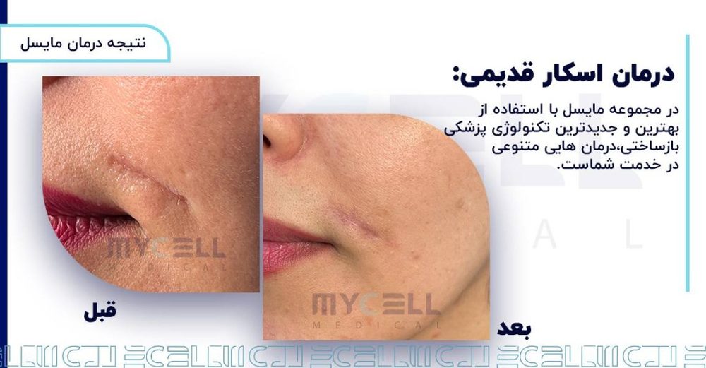 نتیجه قبل و بعد درمان اسکار قدیمی و جای بخیه در مشهد — ساختمان پزشکی مایسل