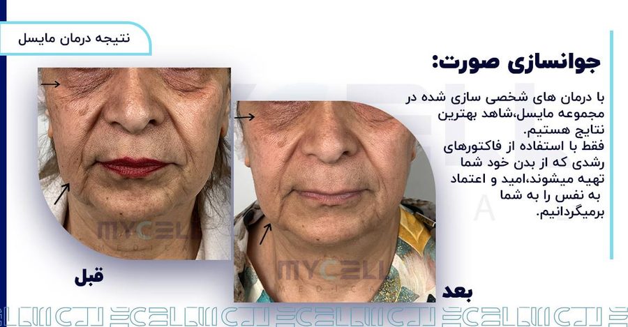 نمونه درمان پوست در مایسل 1
