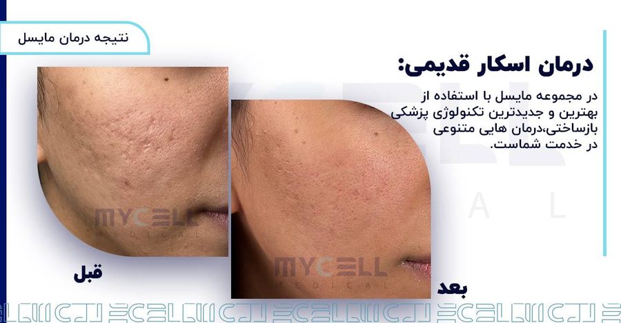 نمونه درمان پوست در مایسل 2