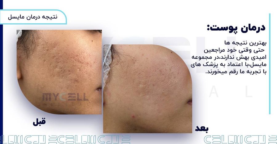 نمونه درمان پوست در مایسل 4