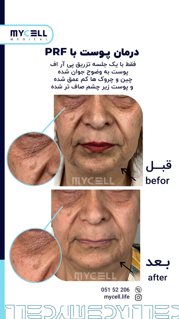 نمونه درمان پوست در مایسل 6