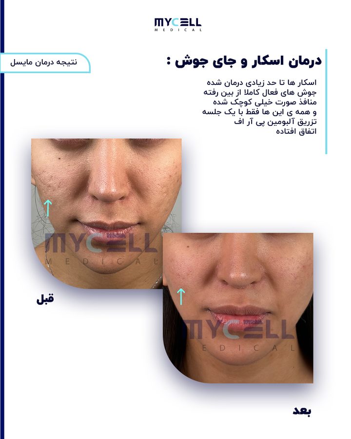 نمونه درمان اسکار در مایسل 7