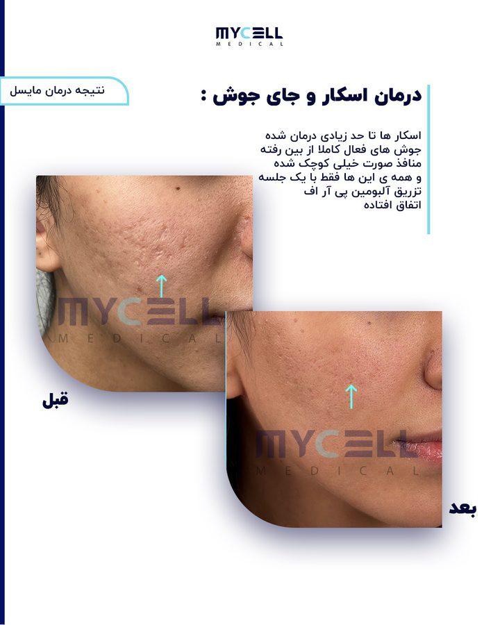 نمونه درمان اسکار در مایسل 8