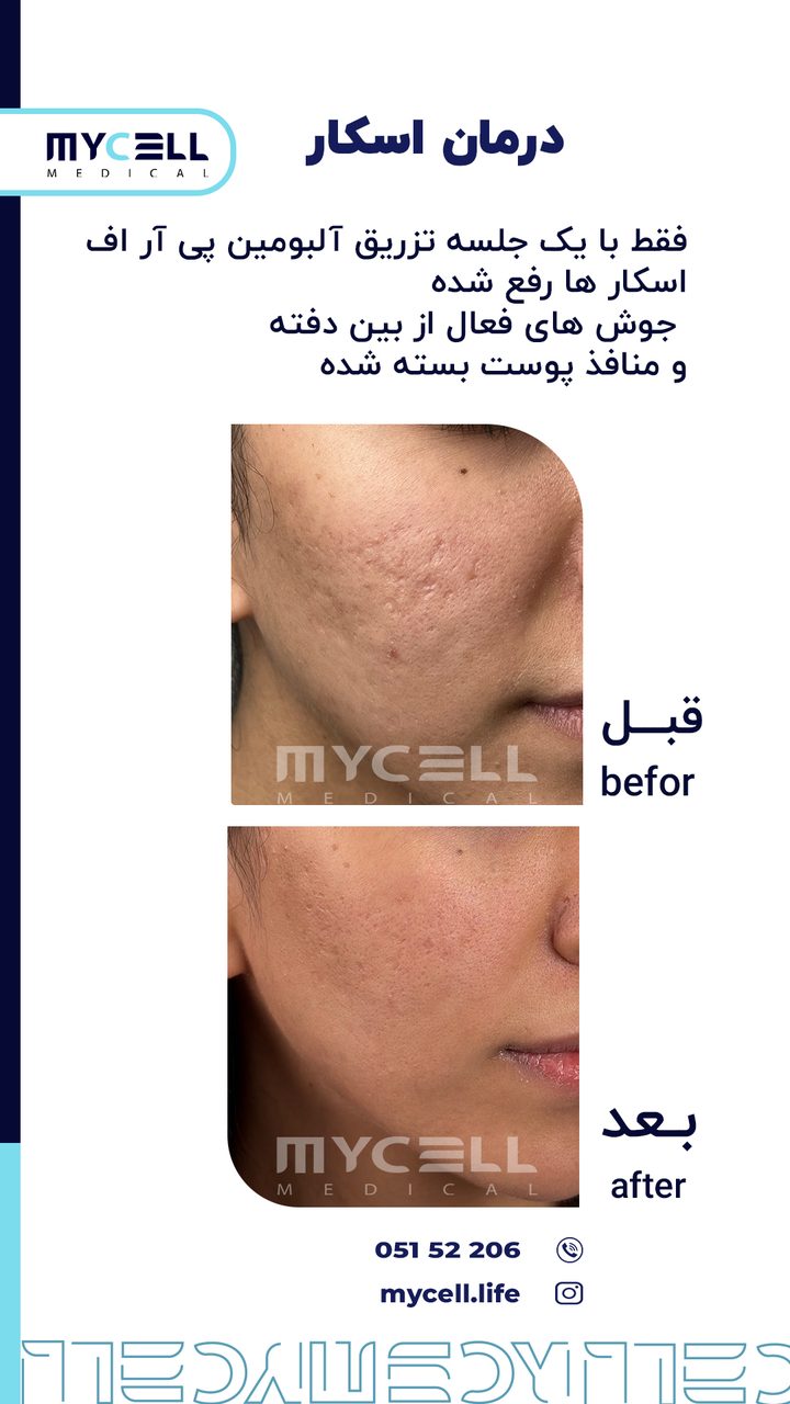 نمونه درمان اسکار در مایسل 9