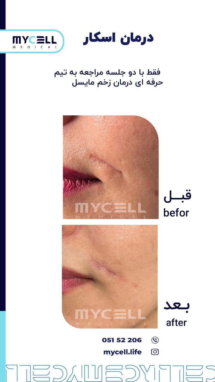 نمونه درمان اسکار در مایسل 10
