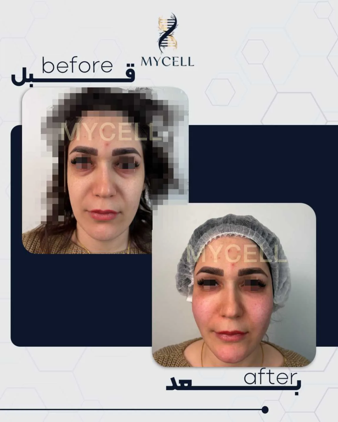 جوانسازی پوست در مایسل