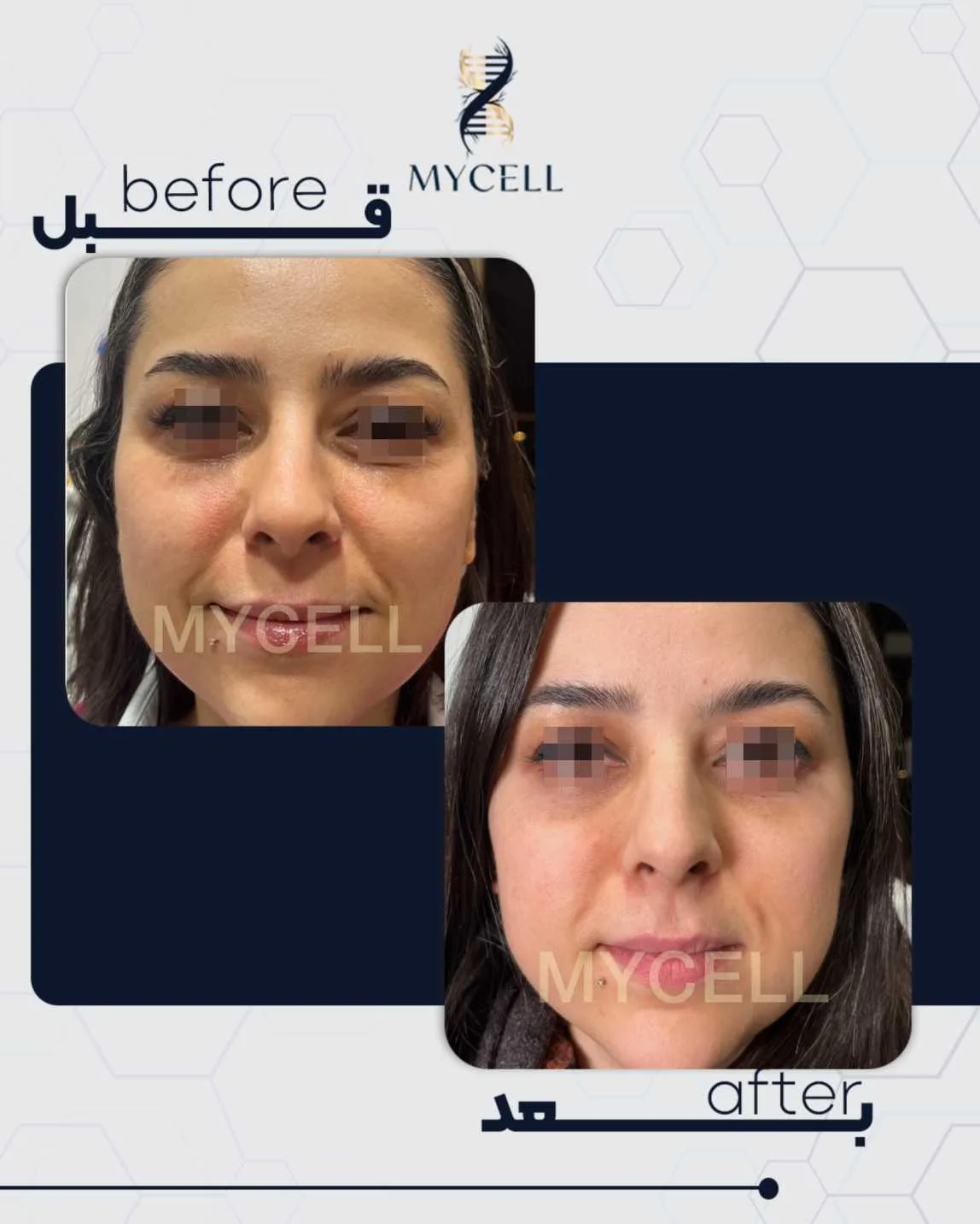 شفاف سازی صورت در مایسل