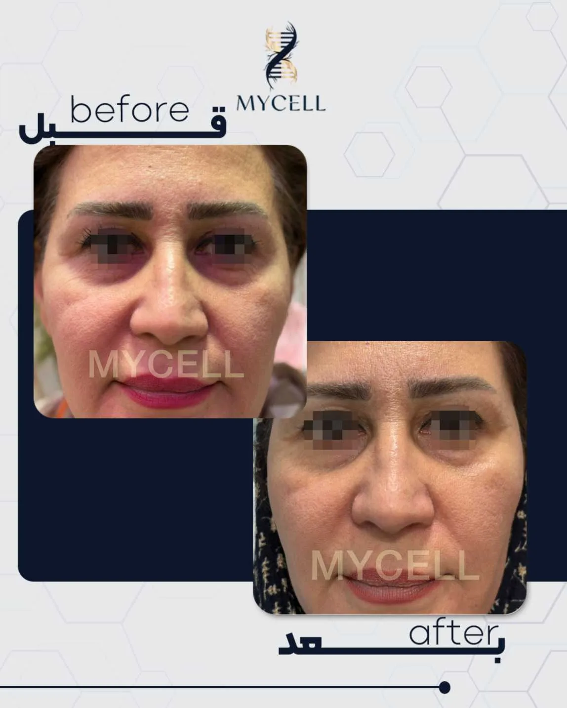 نمونه درمان تیرگی دور چشم