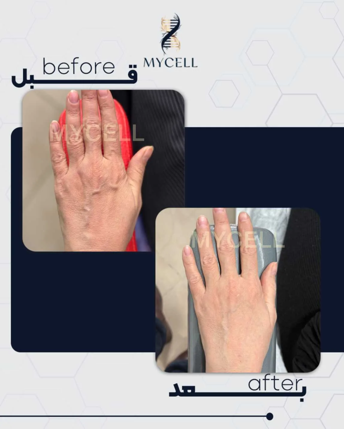جوانسازی پشت دست