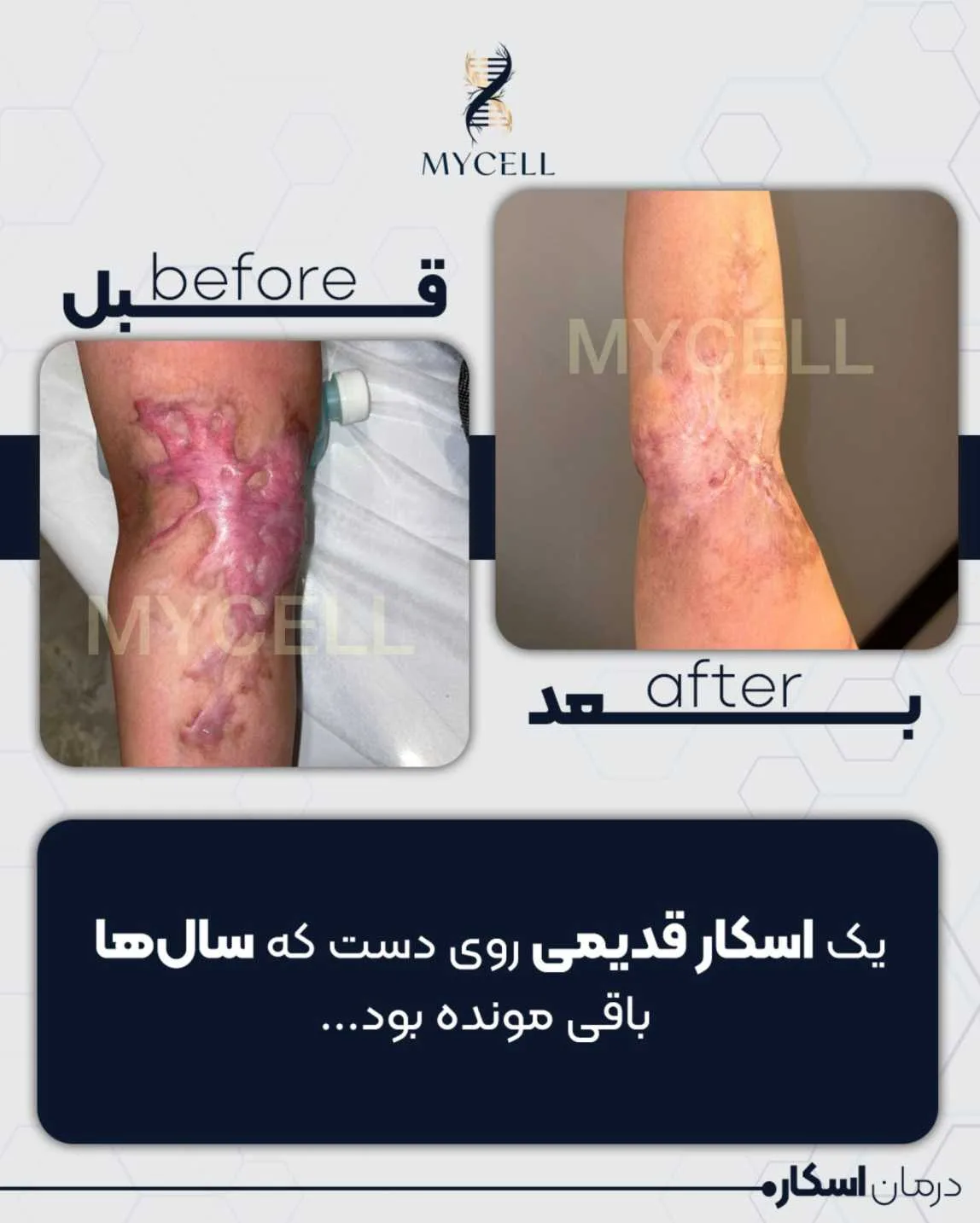 درمان کلوئید در مایسل