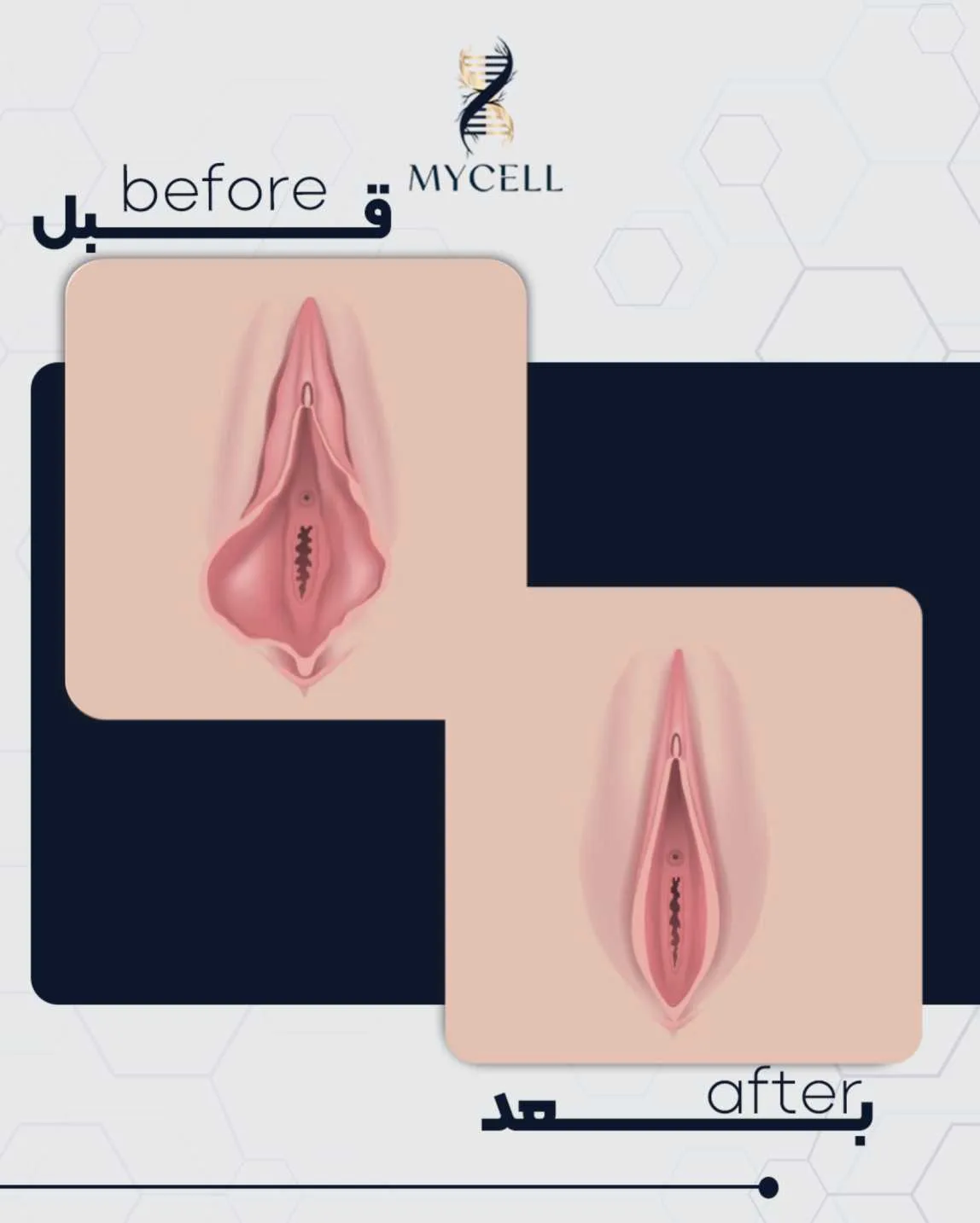 لابیاپلاستی در مایسل